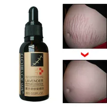 2 шт., средство для Удаления растяжек, эфирное масло для Удаления растяжек, крем для ухода за кожей для беременных