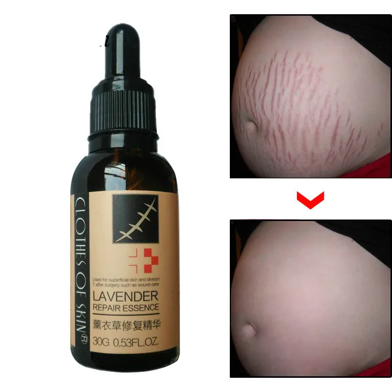 

2pcs Stretch Marks Remover Essential Oil for Stretch Mark Removal Maternity Slackline Pregnant Repair Skin Care Treatment Cream