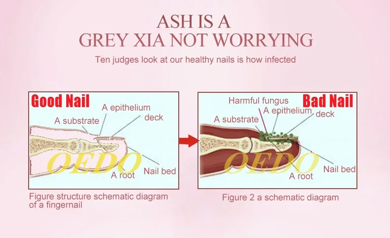 OEDO Здоровый Уход за ногтями травяной грибок ногтей ремонт Эфирное масло для рук и ног яркий белый носок для удаления грибка инфицированных ногтей