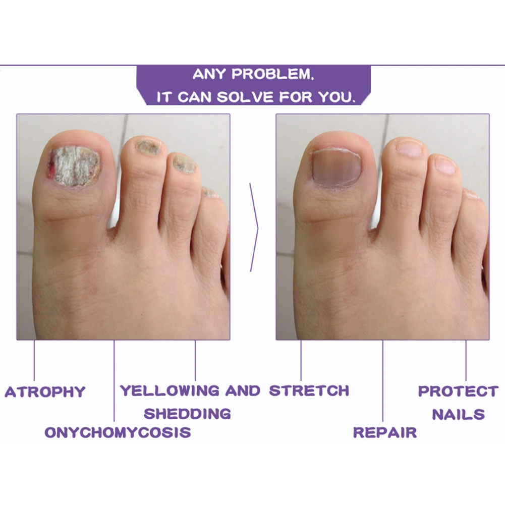 френч на ногах. нога на ногу. гриьое ногтей наиногах. на сколько вырастают ногти на ногах. ногти на ногах.