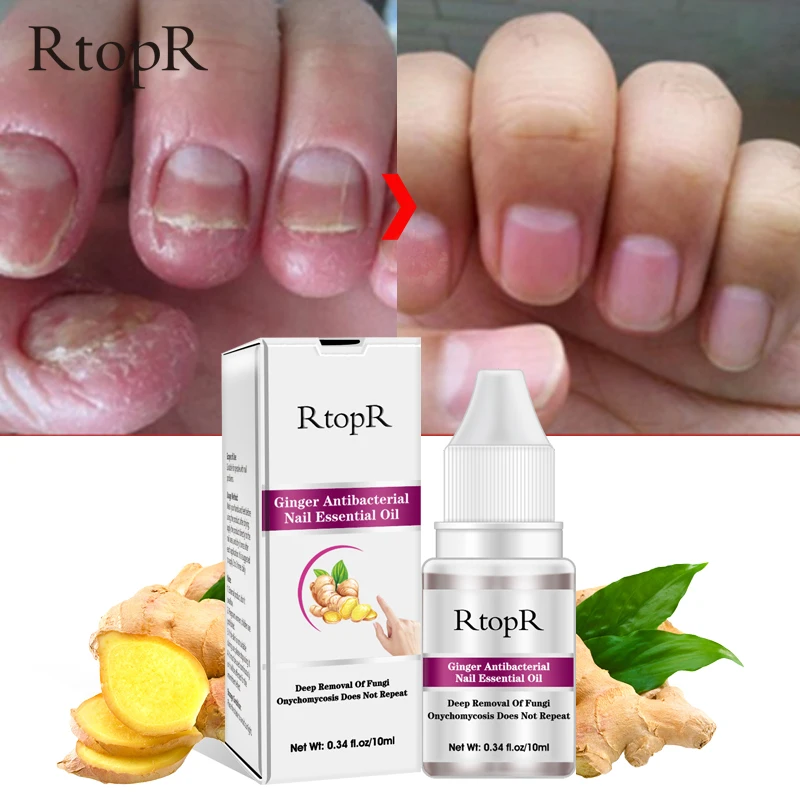 Ginger Antibacterial Nail Treatment Onychomycosis Paronychia Anti