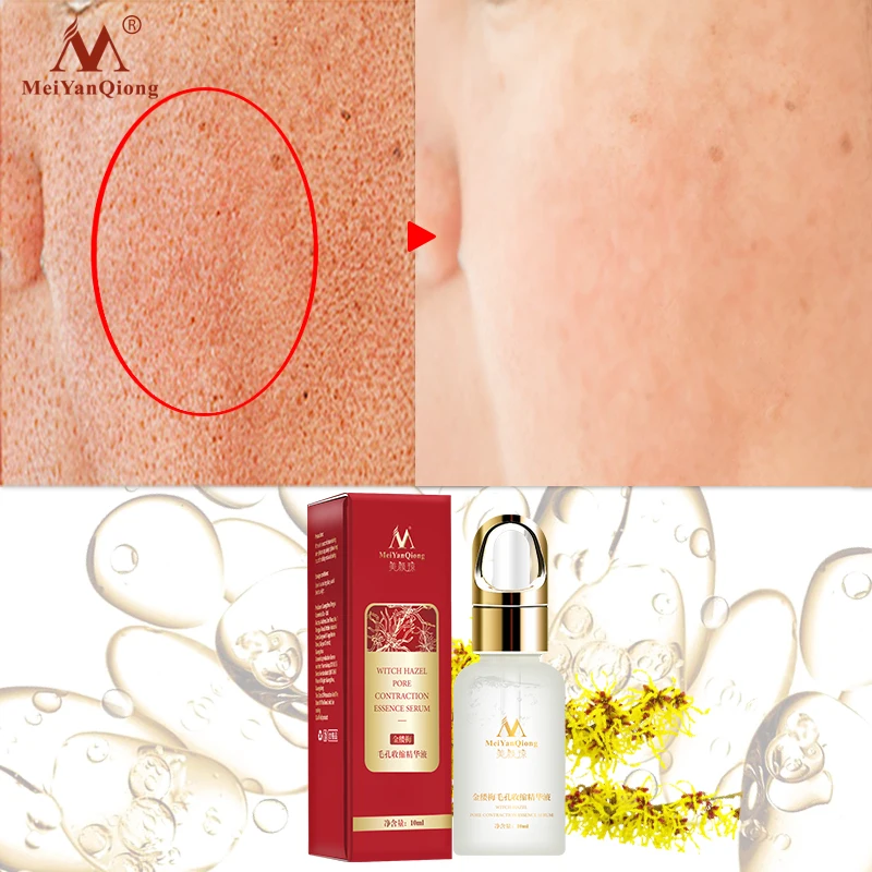 Jual Witch Hazel Pori Mengurangi Esensi Firming Kulit Dalam Pelembab Meningkatkan Elastisitas Kulit Mencerahkan Kulit Wajah Perbaikan 10 Ml