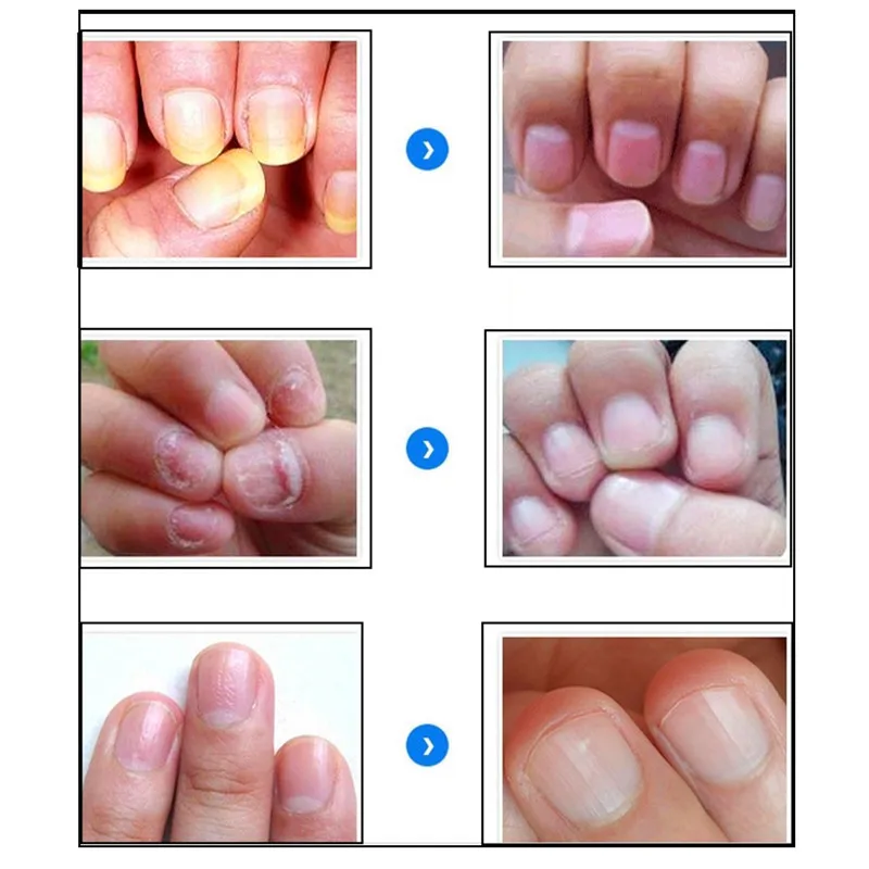 MeiYanQiong Fungal Nail Treatment Feet Care Essence Nails and Foot Whitening Toe Fungus Removal Nail Gel Treatments