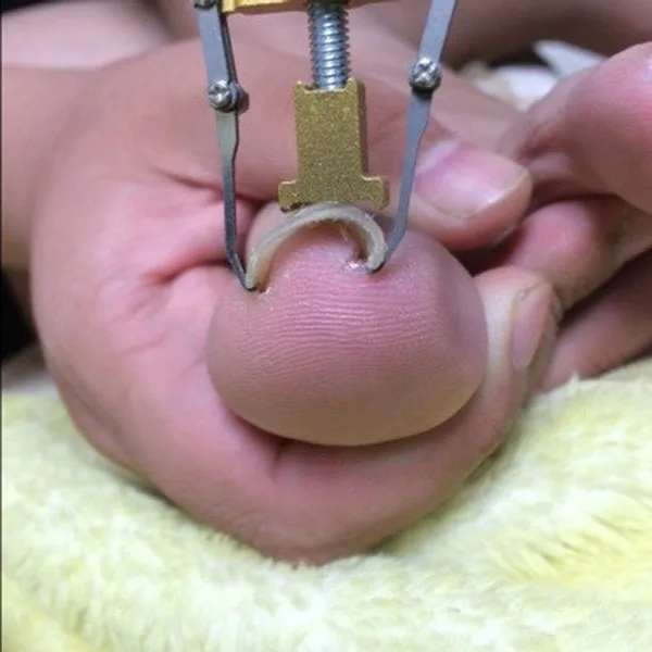 ngrown toe pedicure foot nail care tools file for feet orthotic