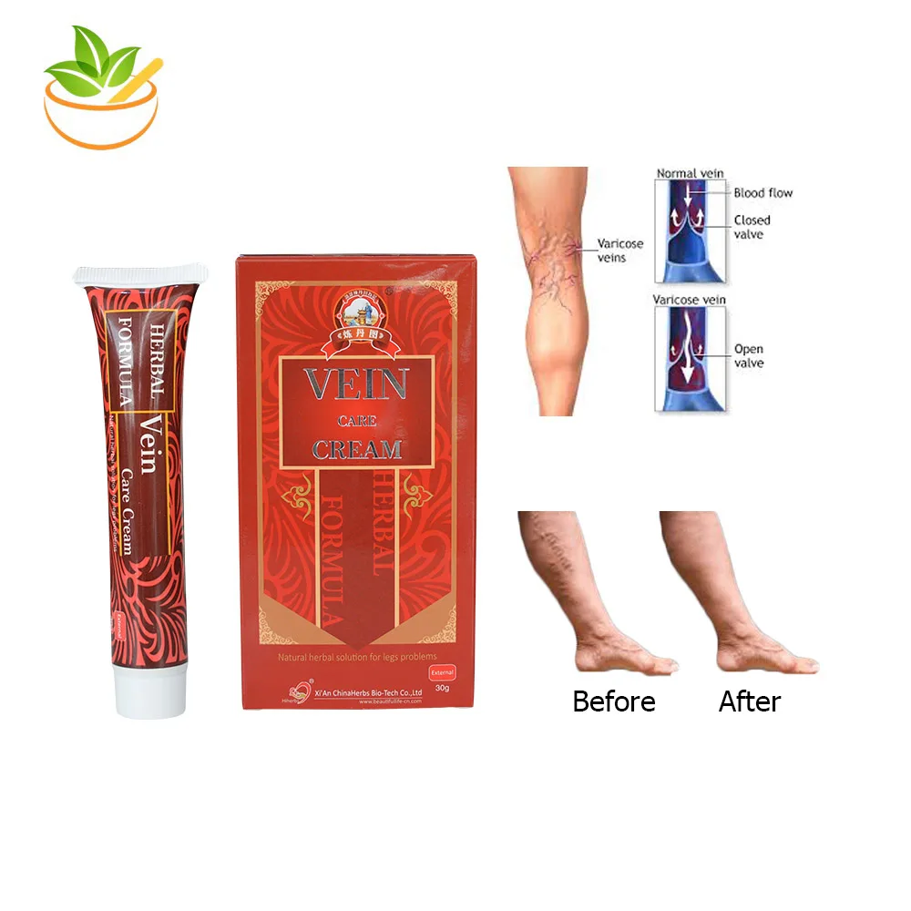 5 حزم الدوالي كريم العلاج فعالة علاج التهاب الأوعية وريدي العنكبوت الأوردة الألم دوالي Angiitis الرعاية الصحية