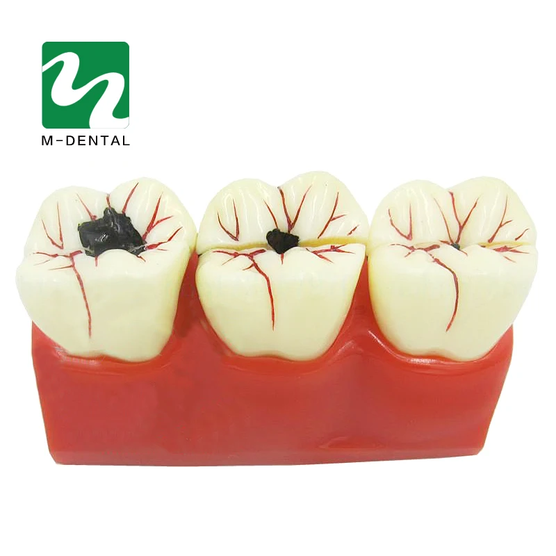 1 шт. стоматологические материалы лаборатория 4 раза кариес разборка модель протез болезни зубов Модель для стоматологической лаборатории