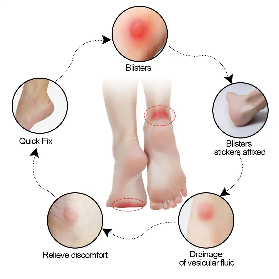 blisters from high heels