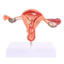 Pathological Uterus Ovary Anatomical Model Anatomy Cross Section Study Tool Medical Science Stationery for School enlarged ovary women ovarian enlargement model the ovaries anatomical model