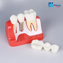 Зубной имплантат зубы модель/имплантат ремонт модель M2017R