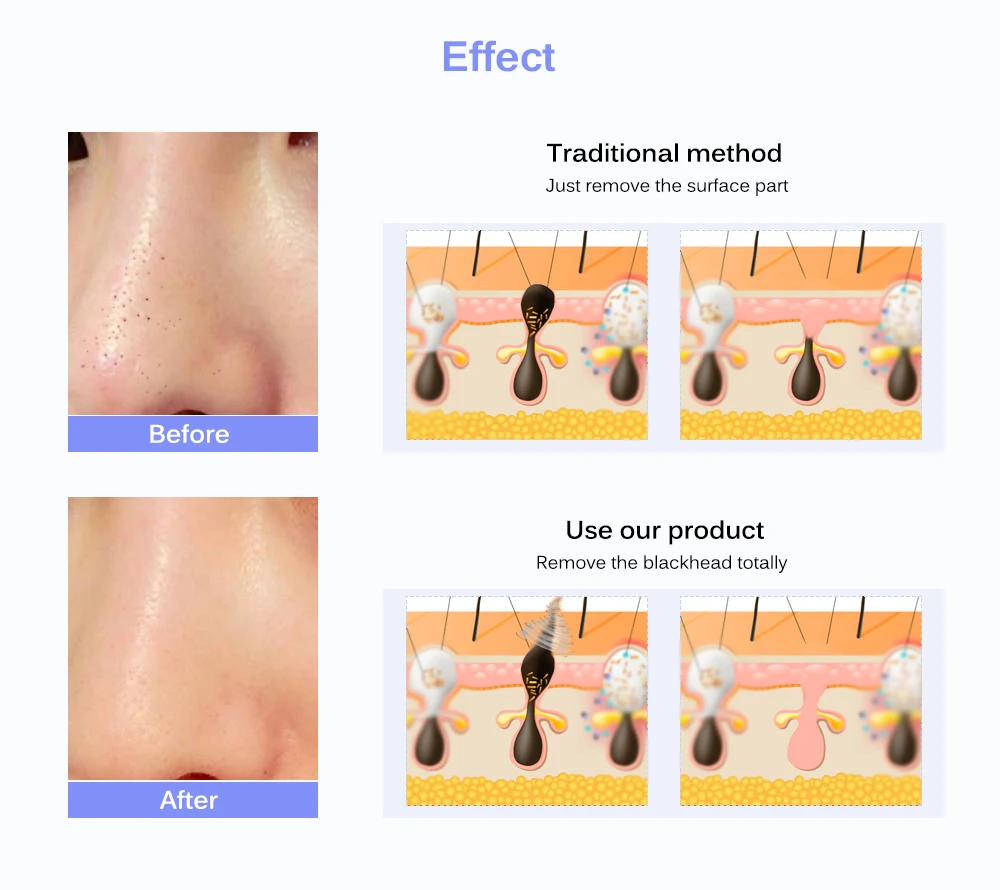 Electric Facial Pore Cleaner Blackhead Remover Acne Cleanser