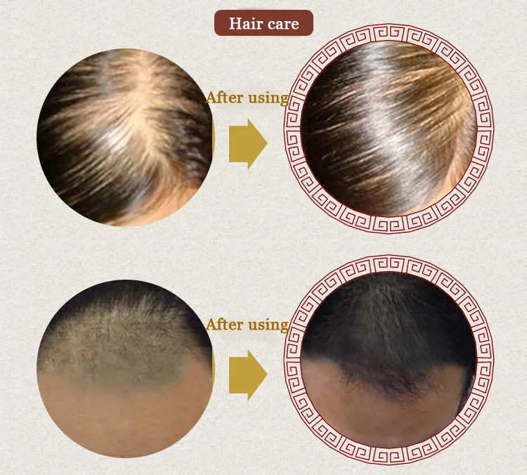 Новая эссенция для быстрого роста волос Эфирное Масло жидкое лечение Предотвращение выпадения волос уход за волосами 20 мл Очищающая Сыворотка для роста волос