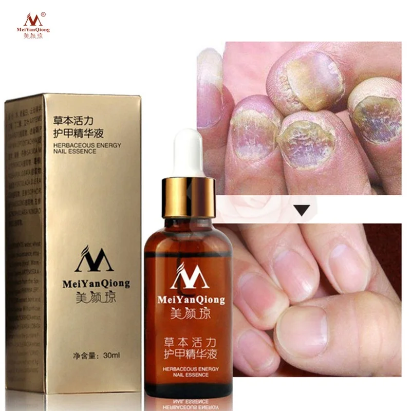 

MeiYanQiong Foot Treatment 30ML Gel Anti Infection Feet Care Essence Nail Foot Manicure Fungus Removal Nail Treatment Gel
