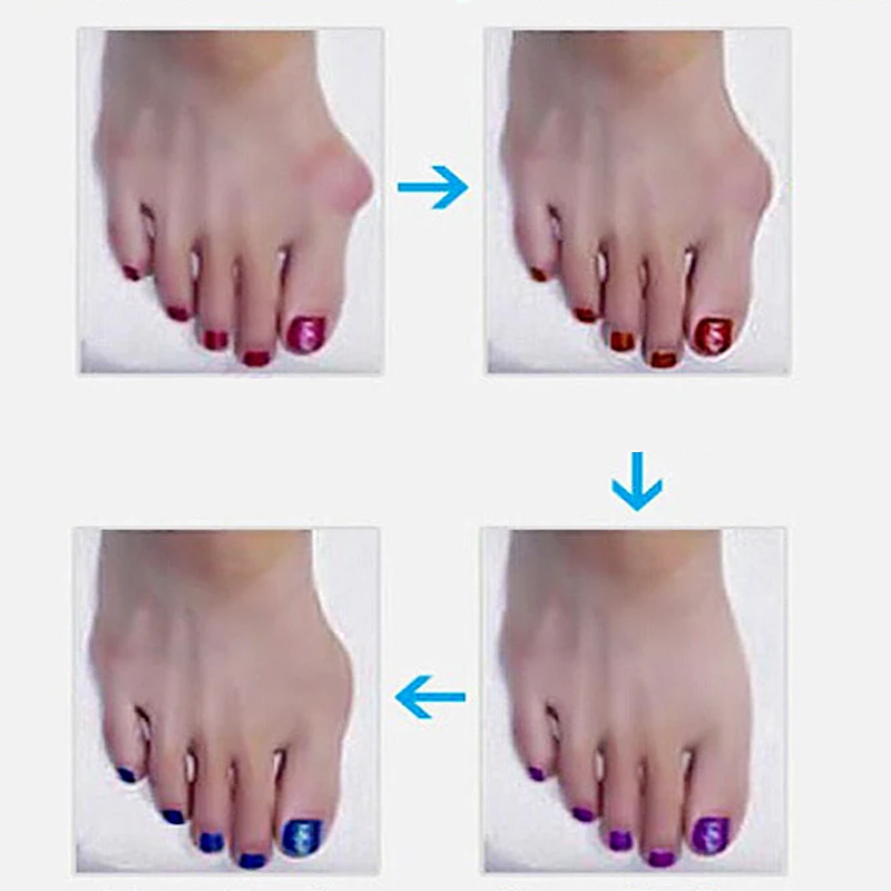 1Pair Beetle-crusher Bone Ectropion Toes Separator Hallux Valgus Corrector Night Foot Care Tools Orthotics Braces Bunion Device