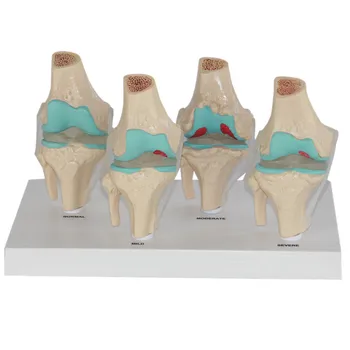

knee joint model knee joint pathological model
