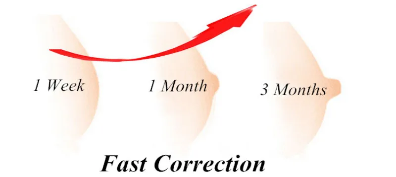 NEW Nipple Aspirator Puller Inverted Nipples Treatment Corrector Flat Niplette Redress Correction Shaper Clip Breastfeeding Aid (2)