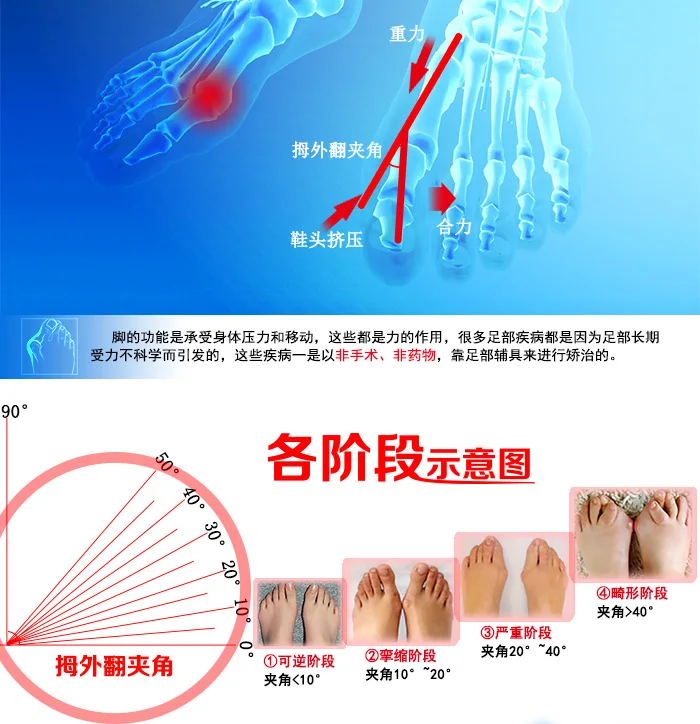 JORZILANO Профессиональный вальгусной ортопедические Поддержка большие пальцы коррекция шину выпрямления кости ортопедии инструменты