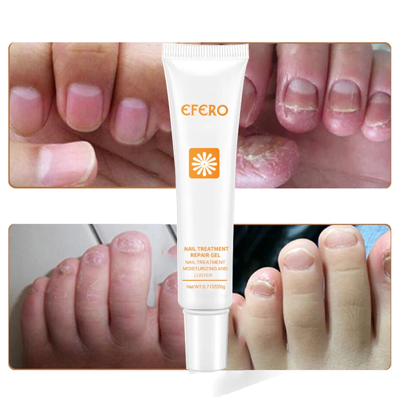 EFERO Nail Repair Essence Serum Toe Nail Fungus Onychomycosis Removal Treatment Nail Care Essence Anti Fungal Nails Repair Cream