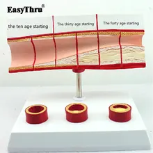 EasyThru Authentic Blood Cholesterol and Age Model Coronary Heart Disease Thrombosis Process Model High-quality Medical Teaching EasyThru Authentic Blood Cholesterol and Age Model Coronary Heart Disease Thrombosis Process Model High-quality Medical Teaching