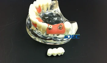 

Dental Model Study Teaching Model Teeth Implant Model Teeth Demonstrates 1PC