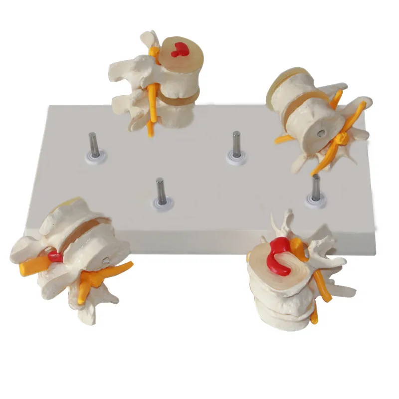 

4 Part Anatomical Human Lumbar Vertebrae Degenerative Disc Disease Medical Model