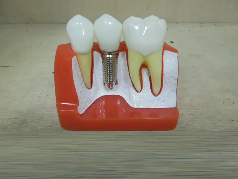 Зубные демонстрация Зубы Модель Implant анализ Корона мост