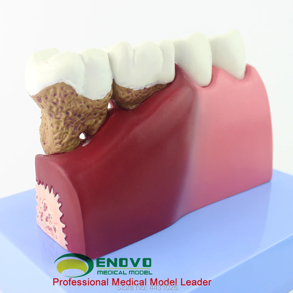 ENOVO зубные модель стоматологических заболеваний
