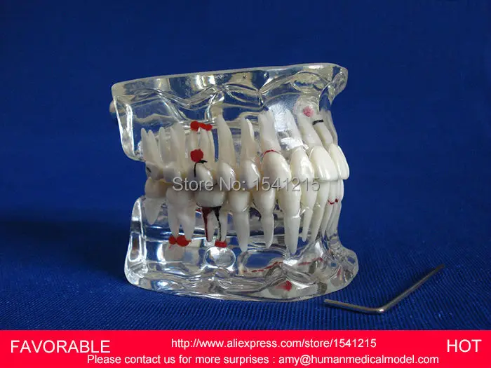 

DENTAL PATHOLOGY MODEL ANATOMICAL MODEL TEETH MODEL DENTAL CARIES ,ADULT DENTAL PATHOLOGICAL DENTITION MODEL-GASEN-DEN046
