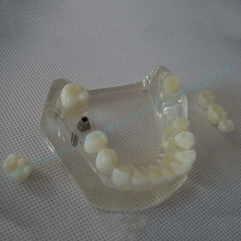 Implant model with bridge and caries 6