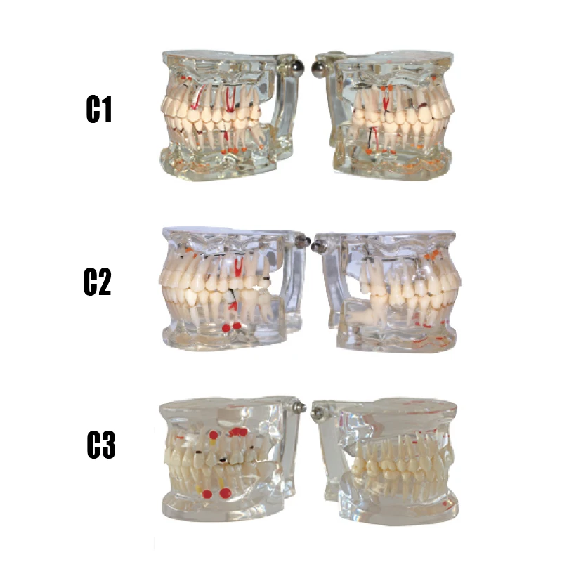 Модель стоматологической практики модель Патологии Модель стоматологического имплантата модель для взрослых и детей