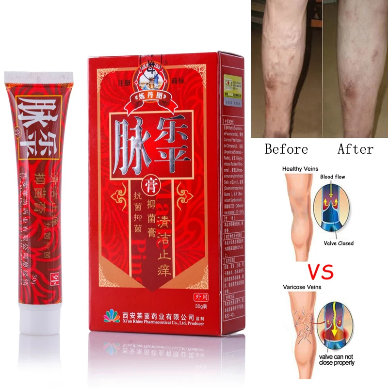 

Varicose Veins Treatment Cream Ointment Vasculitis Phlebitis Spider Veins Pain Varicosity Angiitis Remedy Removal Herbal Cream