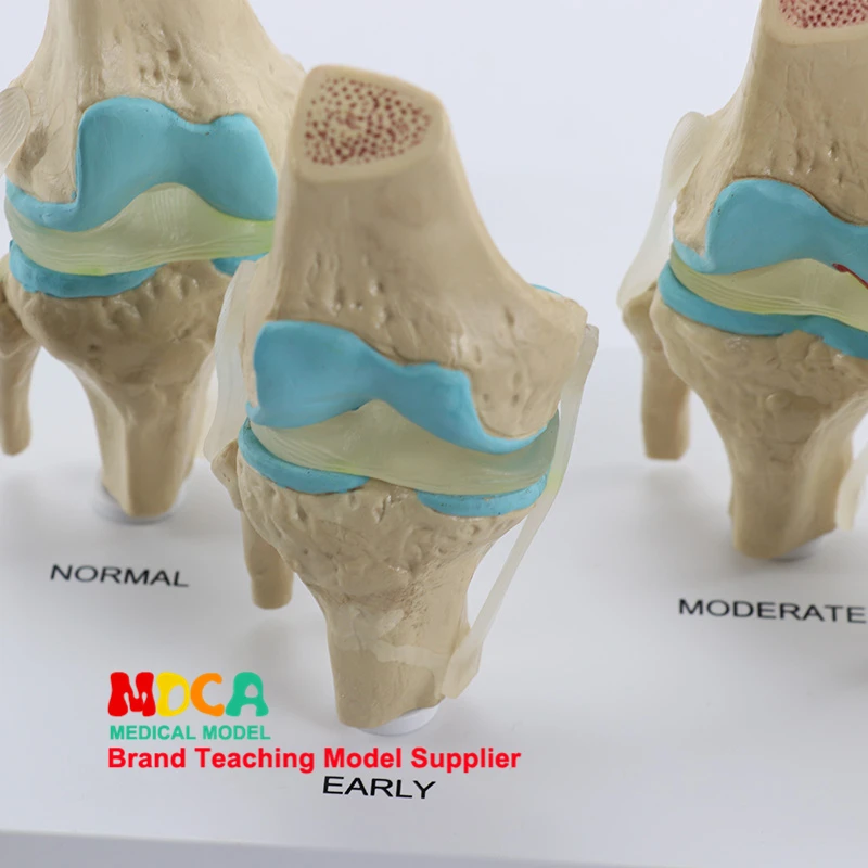 Четыре типа коленного сустава нормальный колено bone болезни в сочетании модель скелета отдела ортопедии медицинское учение MGJ007