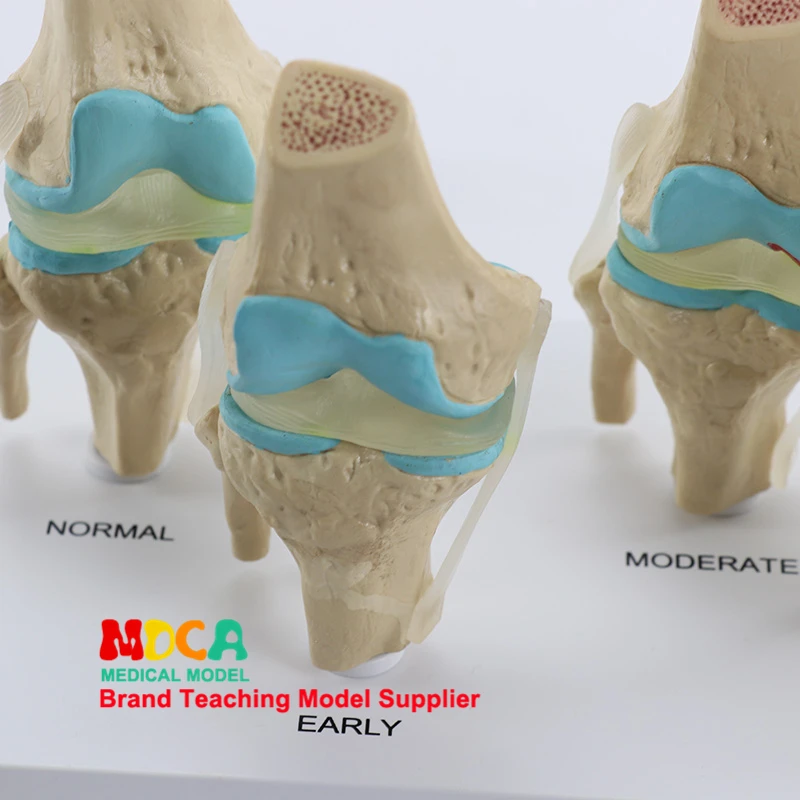 Quatro tipo de Articulação do Joelho Modelo de Esqueleto do Departamento de Ortopedia Joelho Normal Doença Óssea Combinado Modelo Médicos Ensino Mgj007 12 normal doença óssea combinado modelo modelo de
