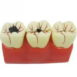4X увеличить Брекеты Уход за полостью рта Новый Стоматологическая модель зубов 4 раза зубы режим пациента модель образования кариеса