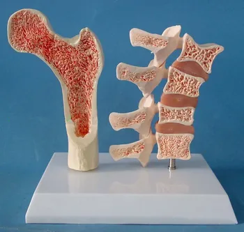 

Human Spine A Comparative Model of Osteoporosis and Morbidity In Human Body Bone Skeleton Femoral Plane Medical Display Model