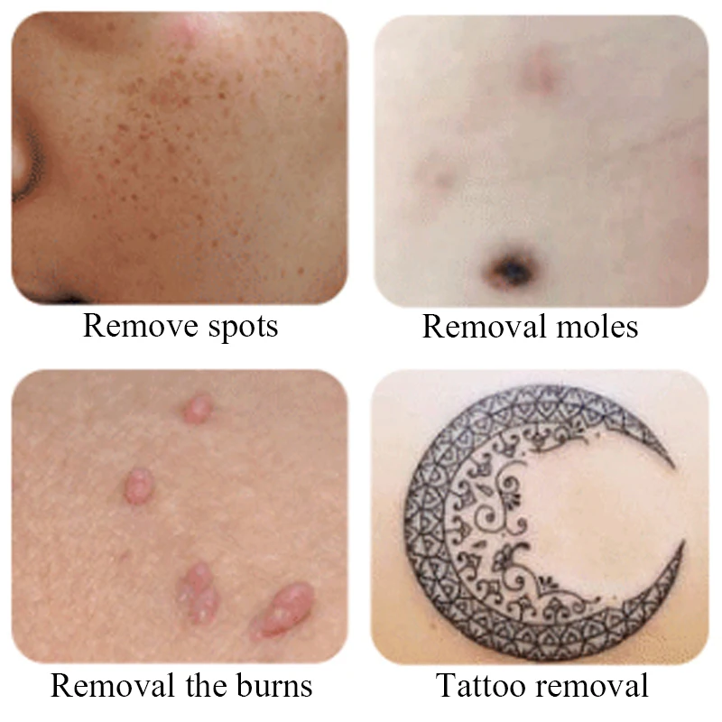 100 tattoo removal black skin laser dermatology tattoo 100 tattoo removal black skin laser dermatology tattoo