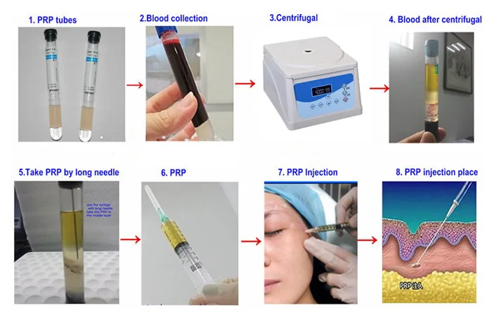 Rico em Ângulo do Rotor para o Cabelo Rotor para 5 Prp para o Platenet Centrífuga Prp Plasma para 5 ml ml 8 7 ml 10 ml ml 15 12 ml Tubo Cabelo da Pele Facial Tratamento Odontológico 5 8ml 10ml 12ml 15ml prp tubo para
