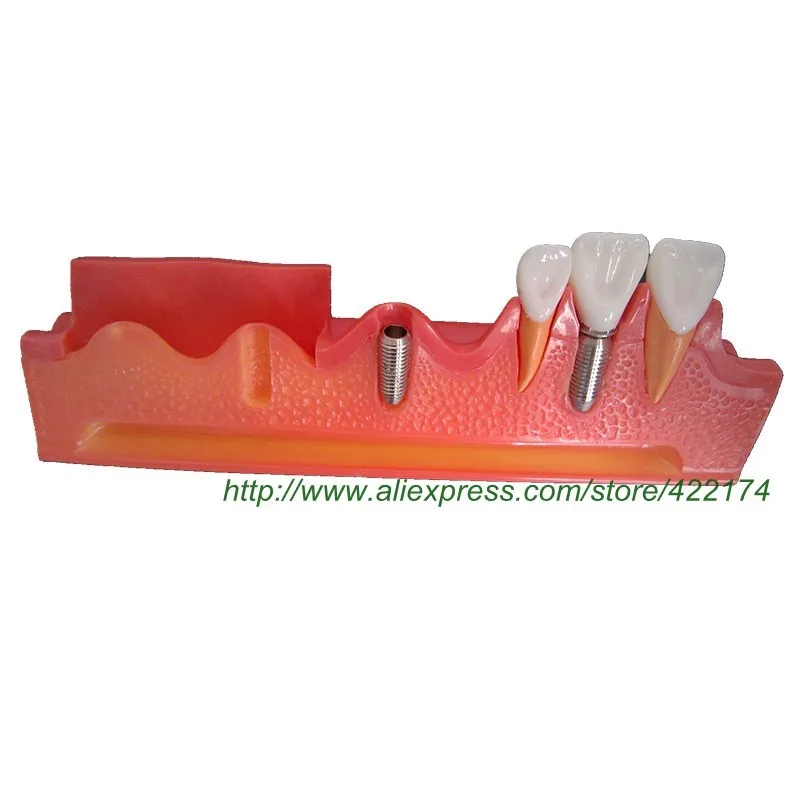 Имплантат демонстрационная модель зубной зуб зубы Стоматологическая анатомическая Стоматологическая модель