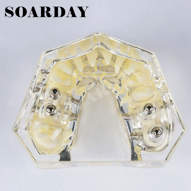 Upper Teeth Implant Dental Model with Bridge for teaching or communicaton (3)