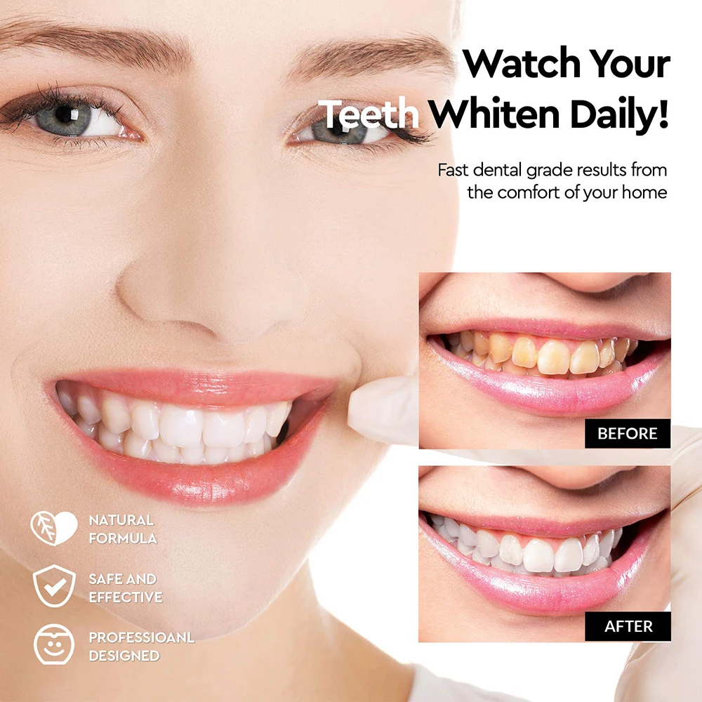 tooth whitening kit (4)