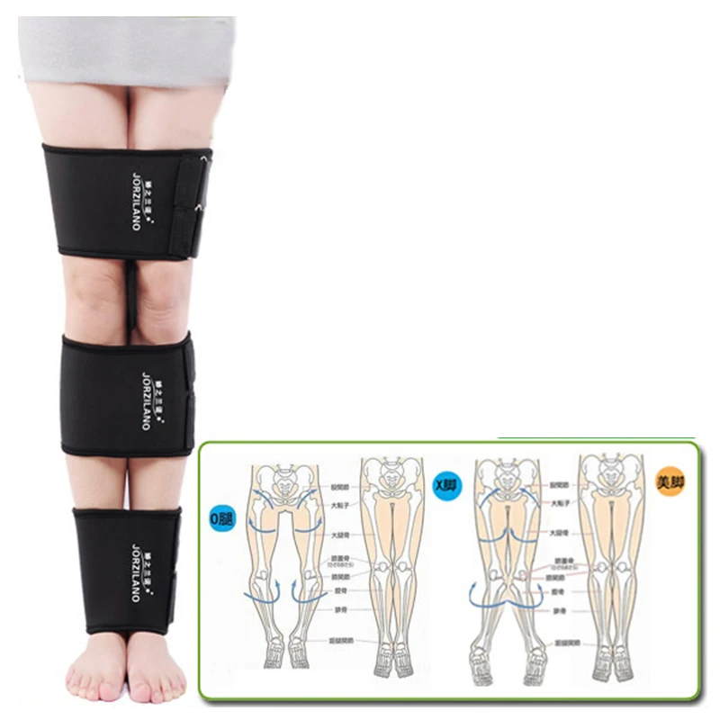 perna endireitamento x o tipo valgus joelho