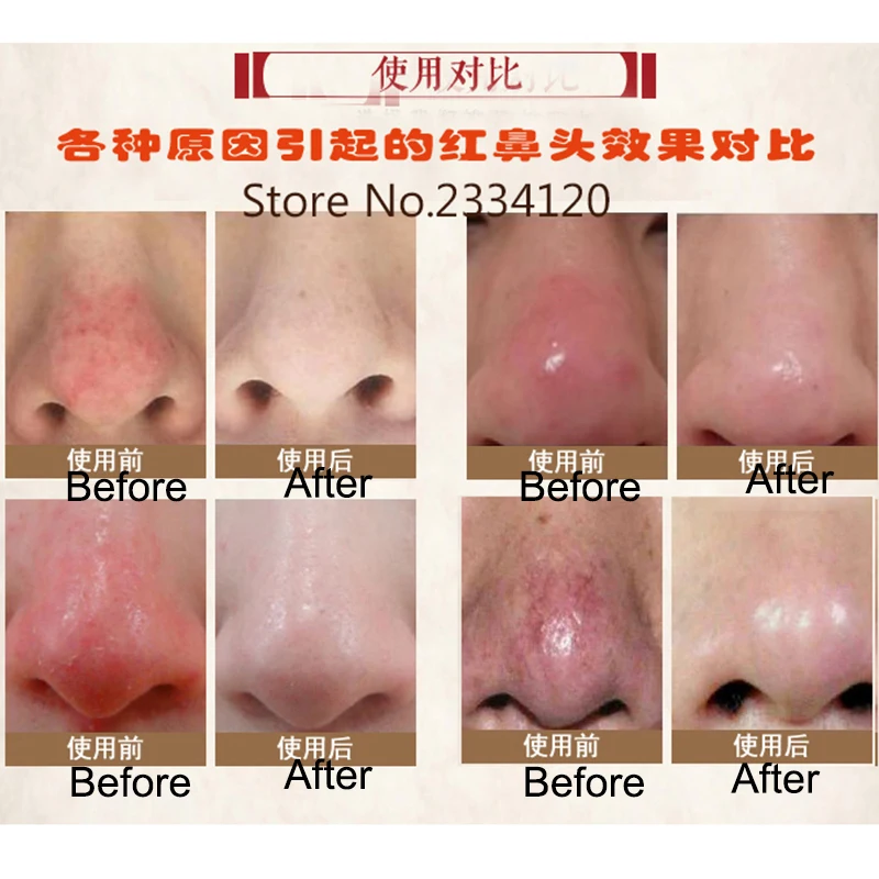 anti nose mites remove acne rosacea cream red nose blackhead how to reduce pore size on nose