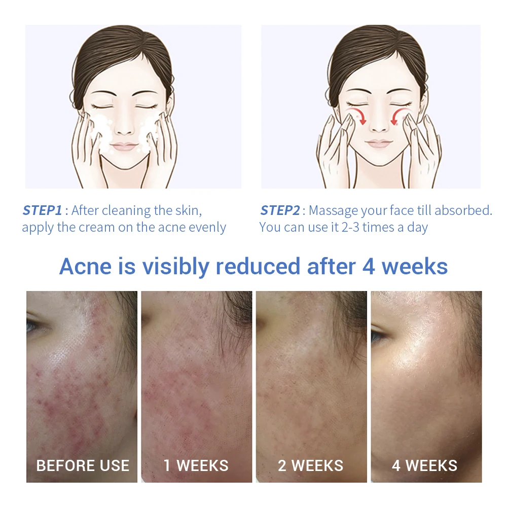 LANBENA Acne Treatment Gel Acne Cleaning Cream Blackhead Remover Acne Spots Face Acne Scars Skin Care 1 LANBENA Acne Treatment Gel Acne Cleaning Cream Blackhead Remover Acne Spots Face Acne Scars Skin Care 5