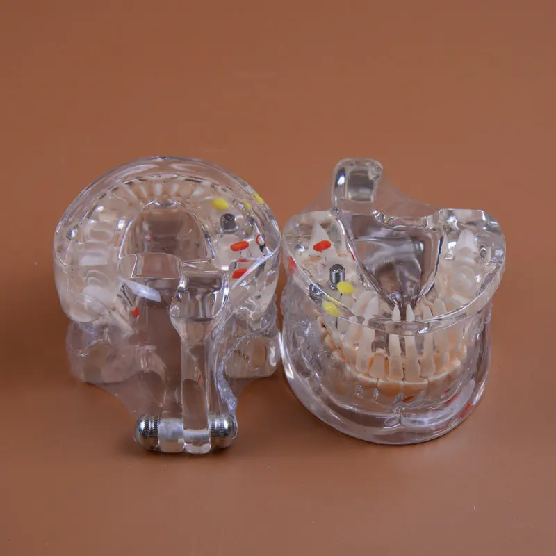 Modelo de Ensino de Odontologia Modelo de Patologia Dental com Implante Modelos de Dentes Modelos de Ensino Lote Odontologia Cuidados Orais Anatomia 2 Pçs - 4 Clareamento dos dentes