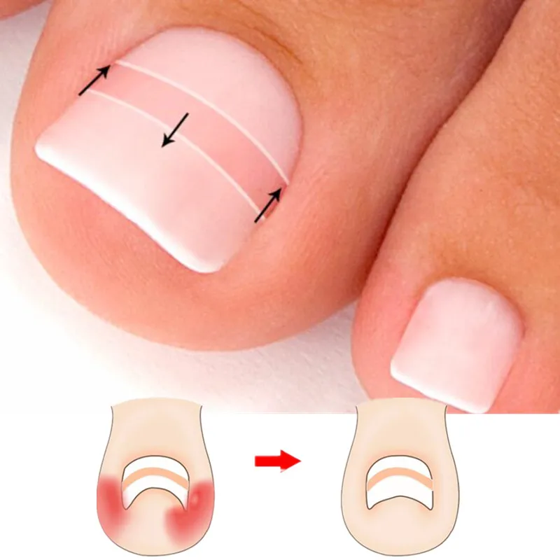 

Hot 10pcs/box Ingrown Nail Correction Toe Sticker Patch Paronychia Correction File Acronyx Wire Corrector Foot Care Tool
