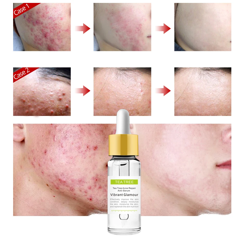 VIBRANT GLAMOUR Tea Tree Acne Eliminating Face Serum Remove Acne Scar Shrink Pores Oil Control Skin Care Whitening Moisturizing