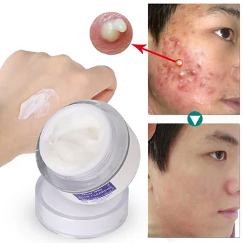 

Acne Treatment Moisturizing Oil-Control Remove Blackheads Pimples Anti-Acne Face Cream