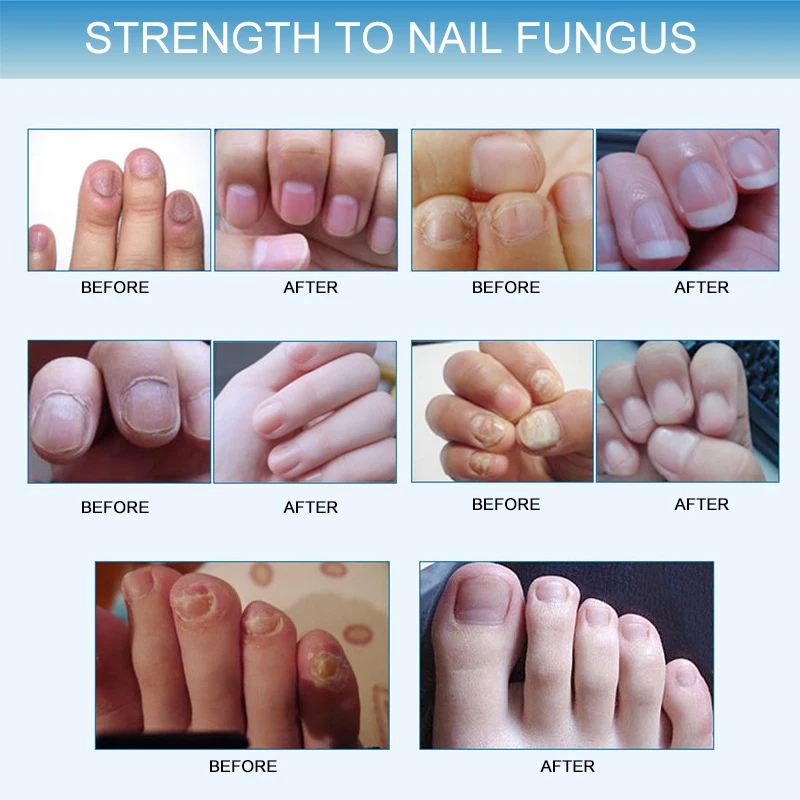 1 шт. Onychomycosis ремонт ногтей жидкая ручка Лечение ногтей от грибка эффективная параоникция грибка гель кутикулы масло/питательное масло TSLM1