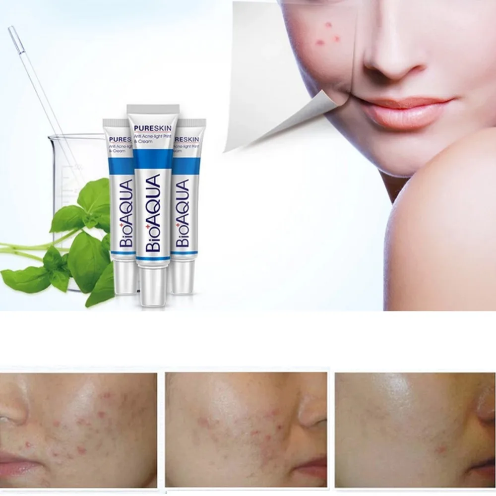 

Removal Acne Scar Marks Cream Treatment Face Care Whitening Moisturizing