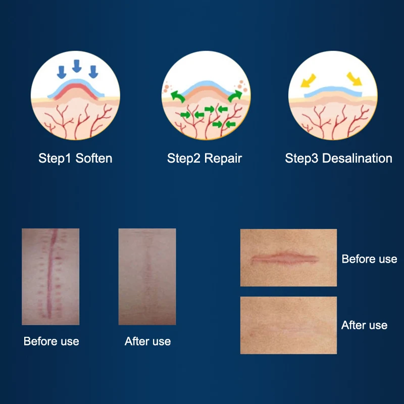 Силиконовый гелевый пластырь для лечения цезарева сечения, хирургическое удаление шрамов, пластырь для лечения угревой сыпи, келоидного ожога, рубцов, восстановления кожи
