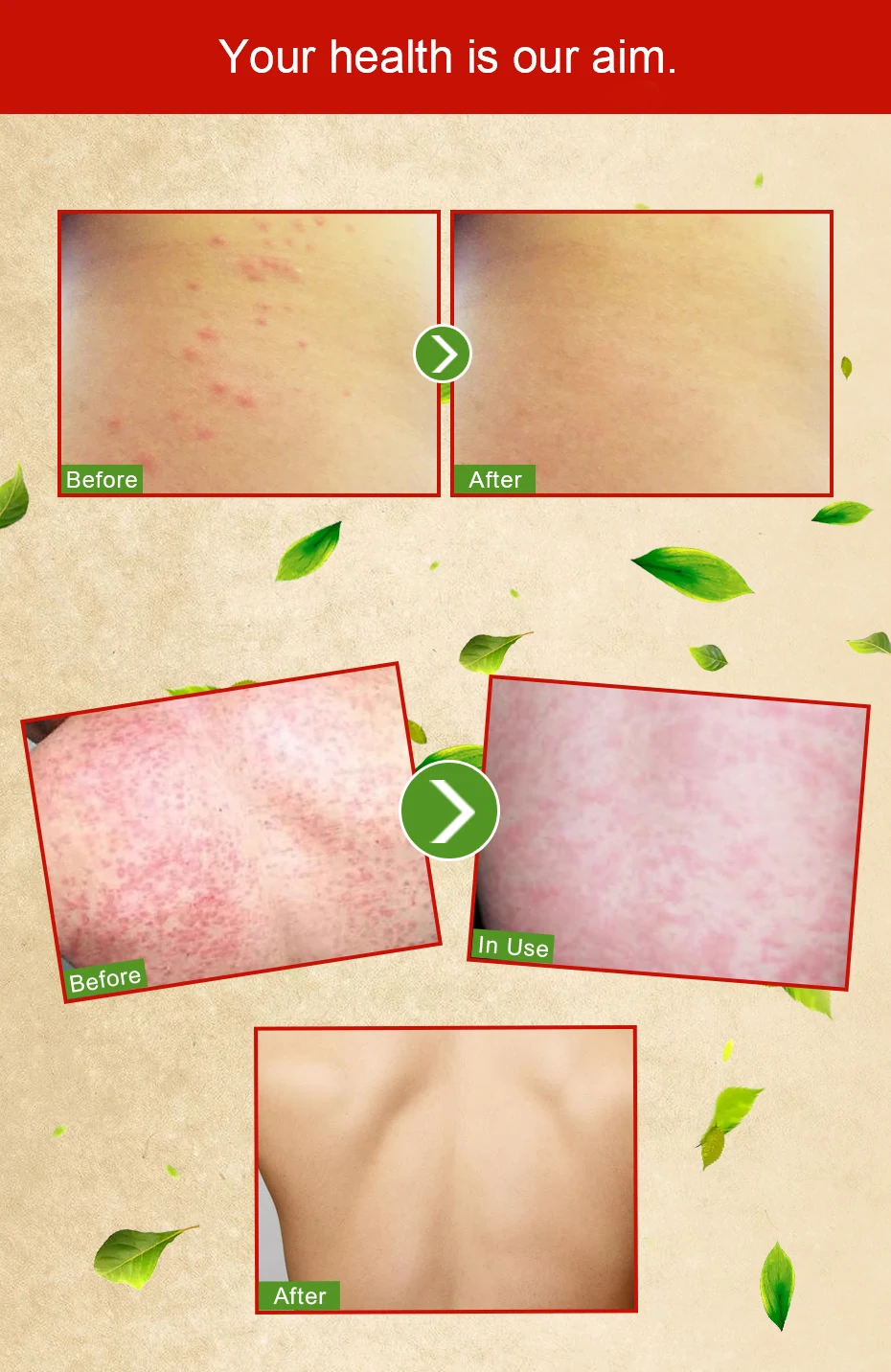 10 шт. Yandaifu псориаз, дерматит, Eczema Pruritus проблемы кожи крем анальгетический артрит 15 г дропшиппинг